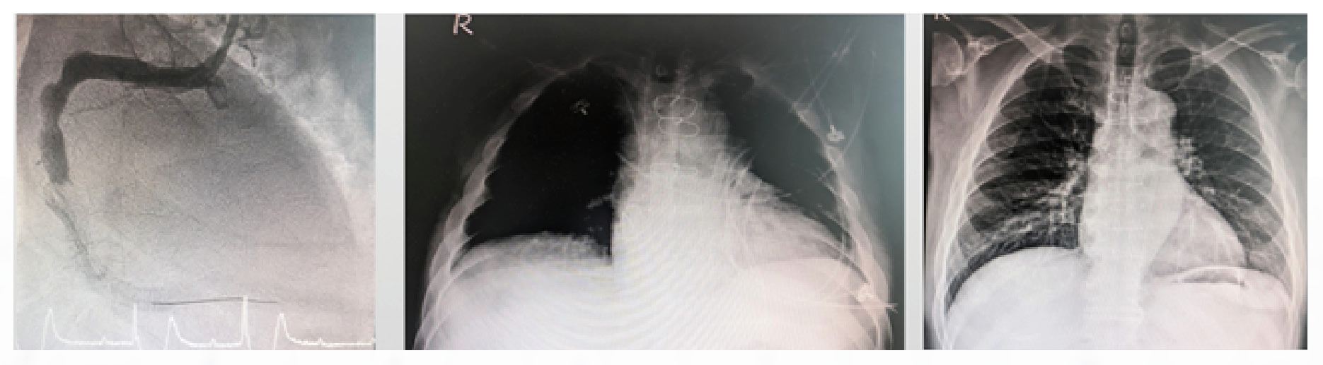 三軍醫訊NO268急性心因性休克救命利器